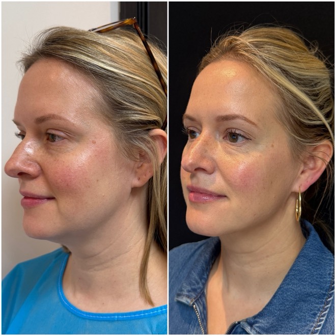 Jawtite before and after