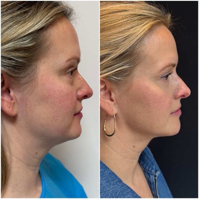 Jawtite before and after