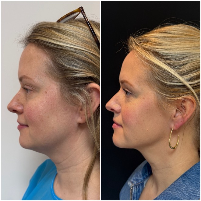 Jawtite before and after