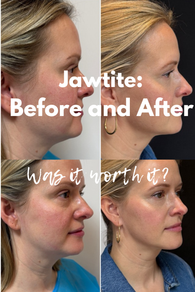 Is Jawtite worth it? Before and after pictures.