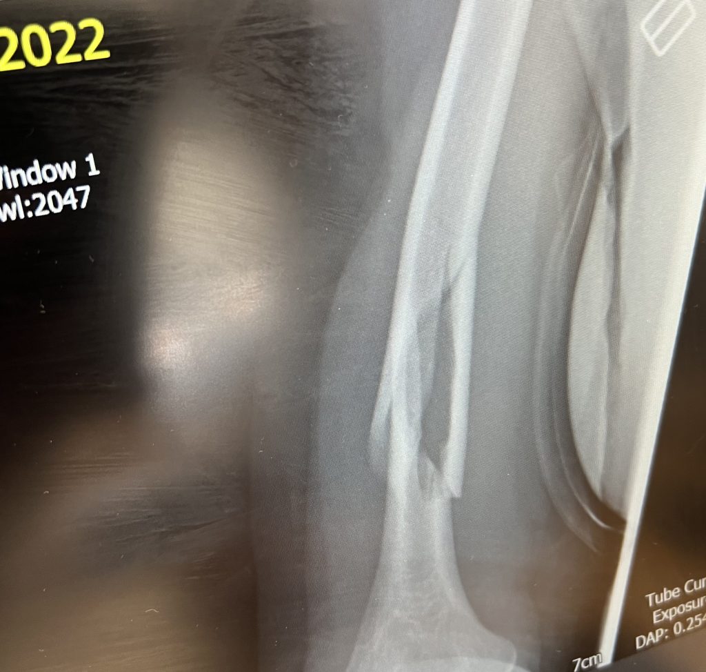 midshaft fracture broken humerus