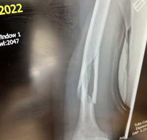 midshaft fracture broken humerus